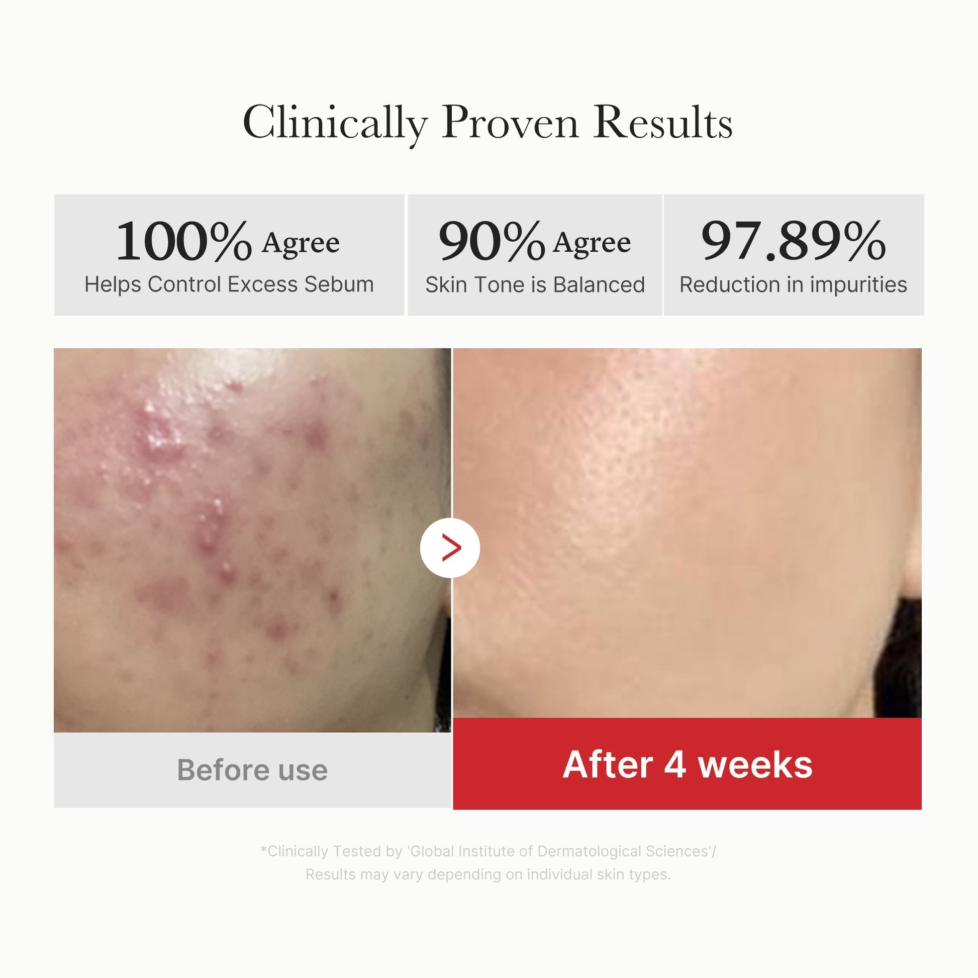 Red Succinic Acid Panthenol Pads for Acne, Breakouts and Pigmentation