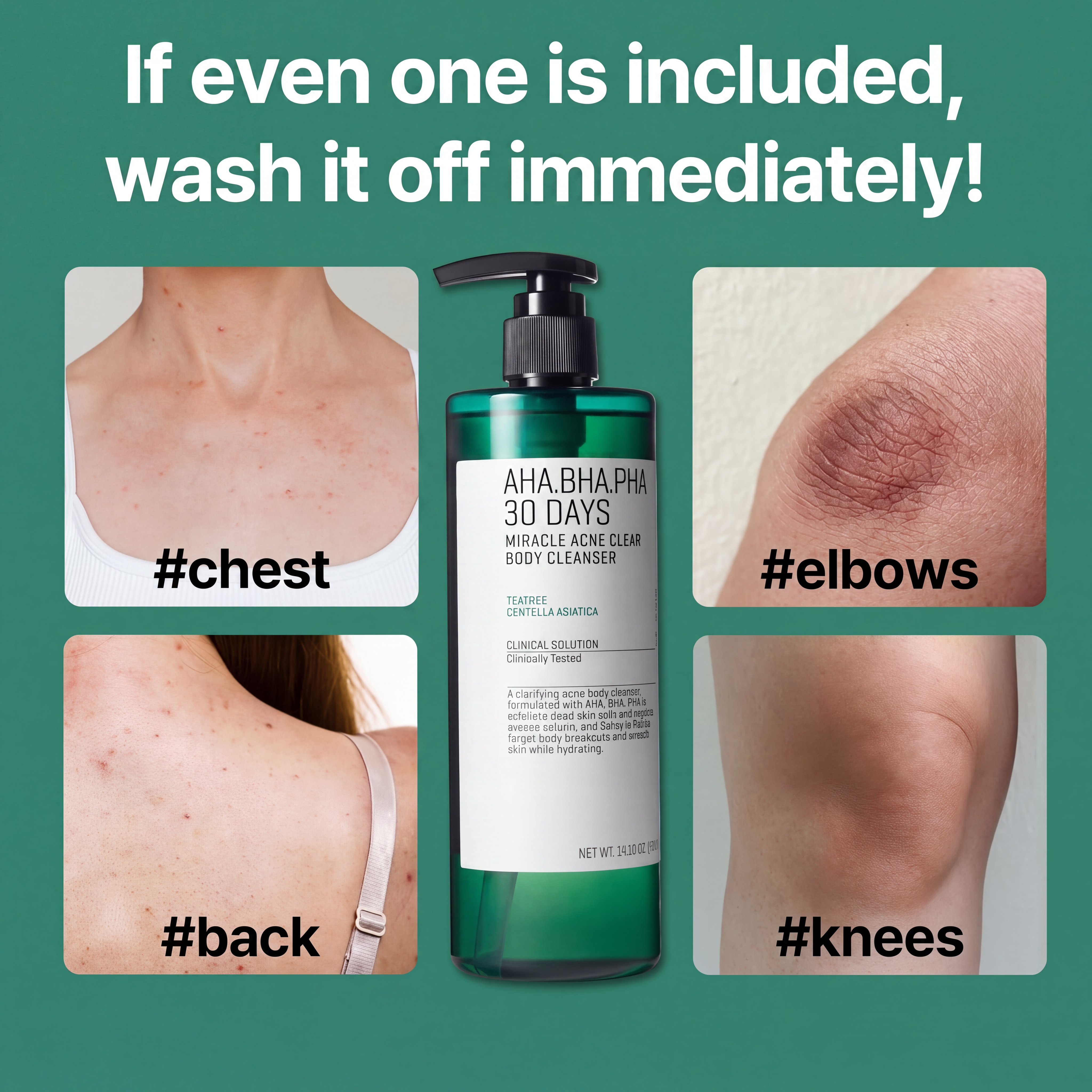 AHA BHA PHA 30 Days Miracle Acne Clear Body Cleanser with Salicylic Acid for Breakouts and Clogged Pores
