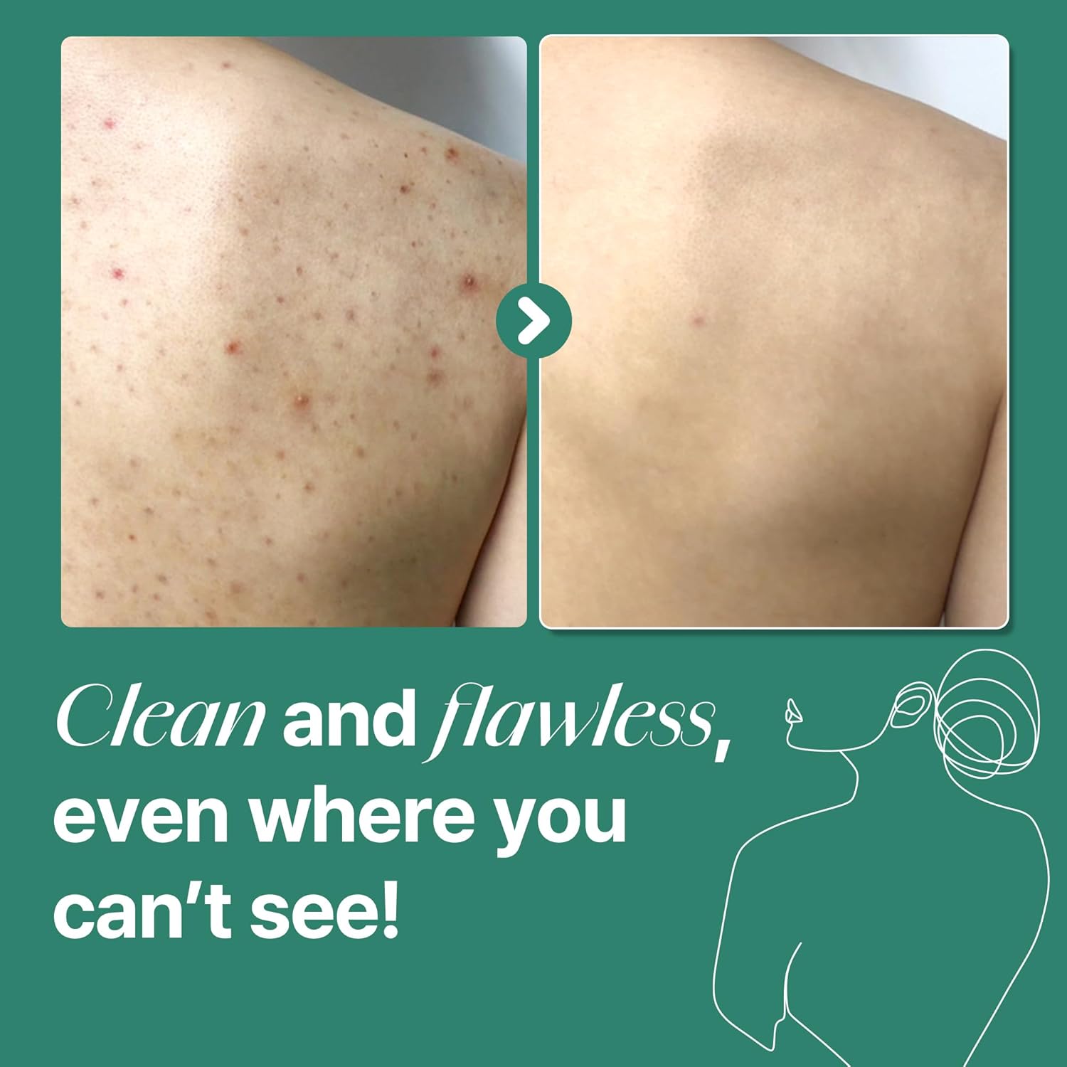 AHA BHA PHA 30 Days Miracle Acne Clear Body Cleanser with Salicylic Acid for Breakouts and Clogged Pores