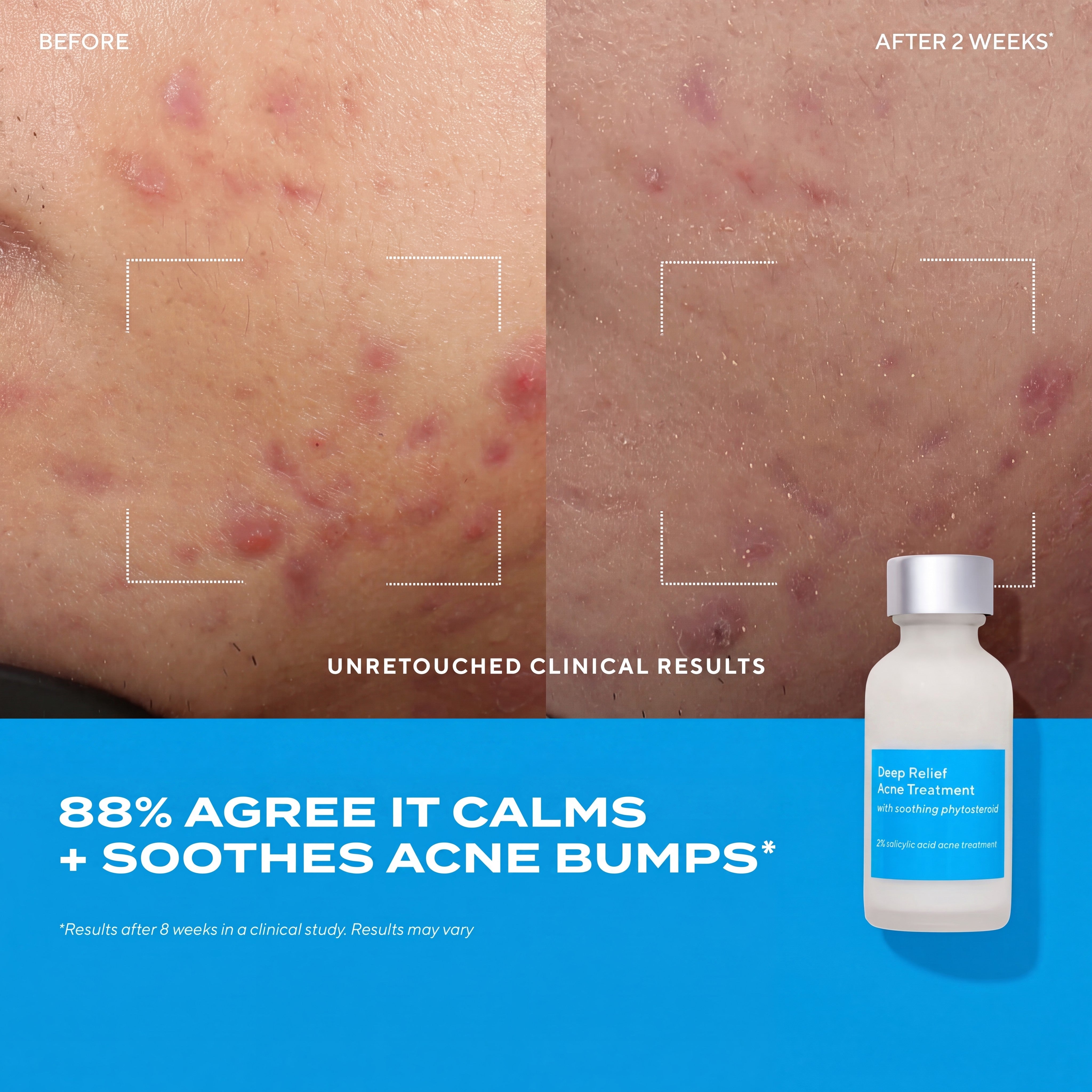 Deep Relief Acne Care for Breakouts, Blemishes & Oily Skin