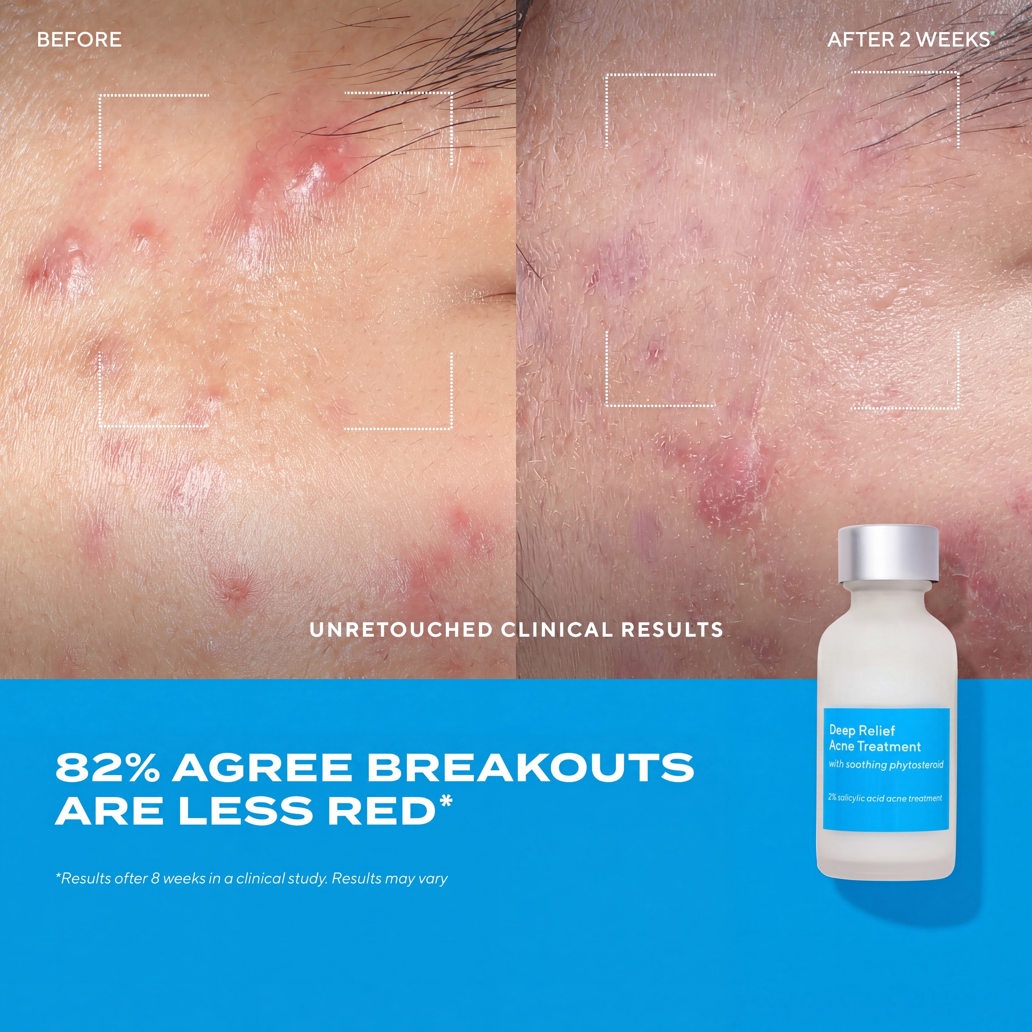 Deep Relief Acne Care for Breakouts, Blemishes & Oily Skin